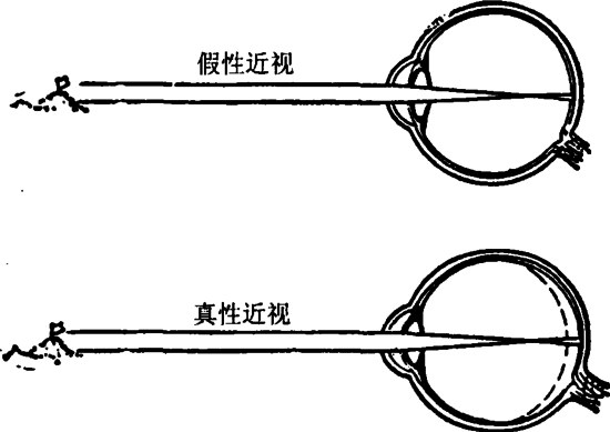 戴眼鏡會讓眼睛近視度數(shù)加深？