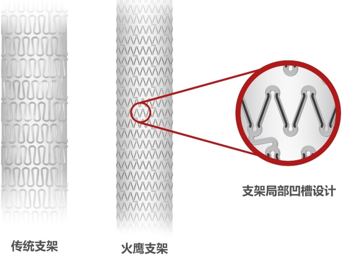 第二代傳統藥物洗脫支架與“火鷹支架”的結構設計對比